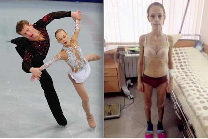 10 Russian celebrities who suffered from anorexia