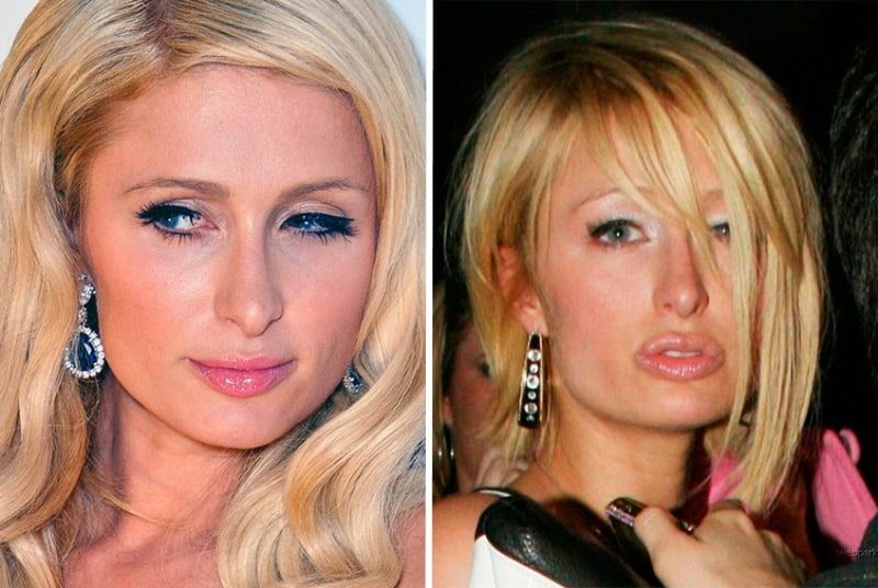 10 Stars Who Have Had Rhinoplasty Success