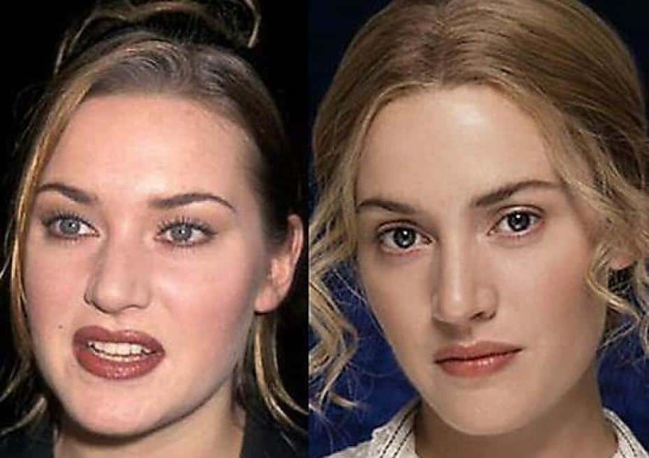 10 Stars Who Have Had Rhinoplasty Success