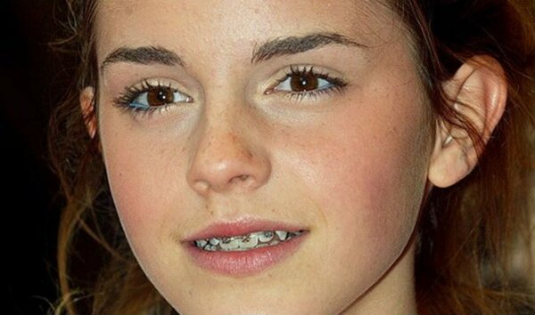 10 stars who were forced to wear braces