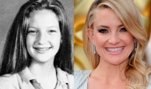 10 stars who were forced to wear braces