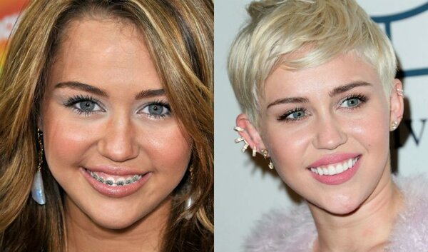 10 stars who were forced to wear braces