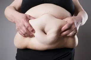 Abdominal obesity — an aesthetic and health problem