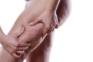 Ah, that orange peel! &#8211; What exactly is cellulite?