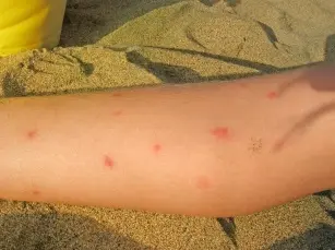 Allergy to blackfly venom - check if you have them?