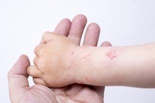 Atopic dermatitis in a child. How to recognize and treat?