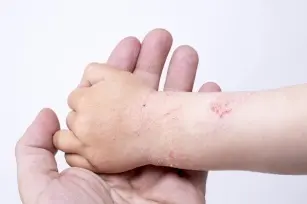 Atopic dermatitis in a child. How to recognize and treat?