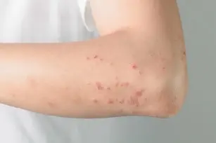 Better watch out for hives! What is it and how to deal with it?