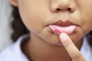 Children&#8217;s canker sores. How to treat them?