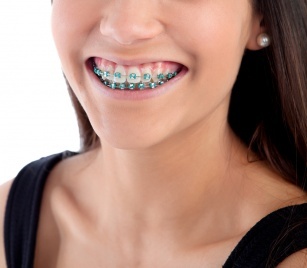 Clean teeth in braces. Check out how to take care of your oral hygiene!