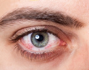 Conjunctivitis &#8211; the most commonly diagnosed eye disease. Find out about the causes and methods of treatment!