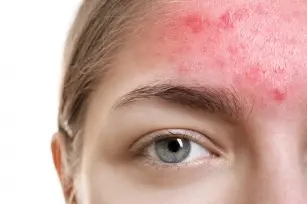 Demodex &#8211; what are the symptoms of demodicosis?