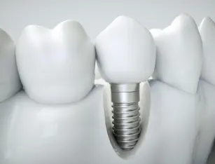 Dental implants &#8211; types, durability and implantation techniques