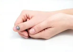 Discoloration on the nails - what do they mean?