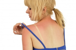 High summer. Learn about natural home remedies for sunburn.