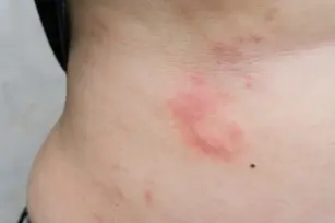 Hives - a dangerous symptom of an allergic condition