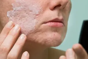 How to get rid of the scar? Are there home remedies?