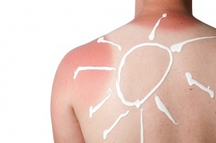 How to relieve sunburn? You will definitely feel relieved after this!