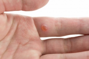 Introducing home remedies for warts! Some will surprise you