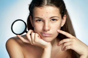 Juvenile acne: what is it, how to treat it? Everything you need to know!