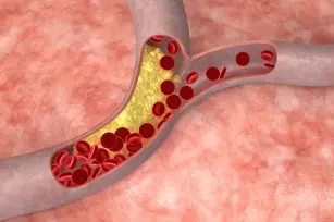 Leg pain and trouble concentrating. Recognize the first symptoms of atherosclerosis