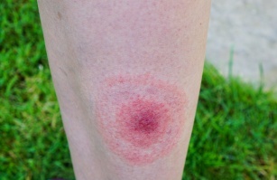 Lyme disease &#8211; symptoms, treatment and prevention