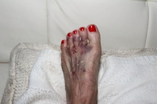 Morton&#8217;s neuroma &#8211; the result of high-heeled shoes!