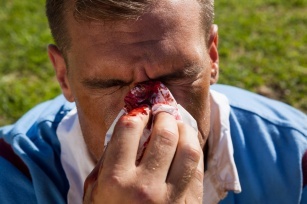 Nose bleeds &#8211; what are the causes of nose bleeds?