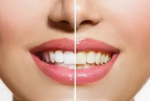 Problem with yellow teeth? Want to whiten them? You have a lot of choice