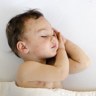 Seborrheic dermatitis. How to care for your baby&#8217;s skin?