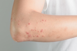 Shingles &#8211; causes, symptoms and treatment of the infectious disease of shingles