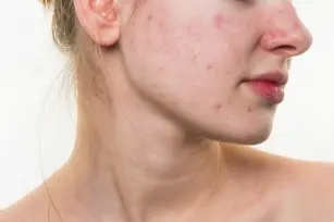 Spider veins, pimples and redness. Symptoms and treatment of rosacea