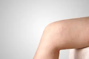 Summer is getting closer and varicose veins keep you awake at night? We have 6 ways to do it!