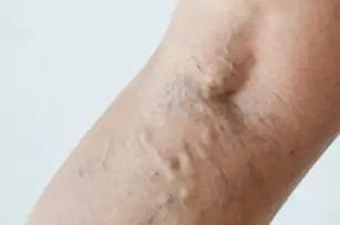 Swelling, pain, heaviness and throbbing - Get ahead of the venous blockage!