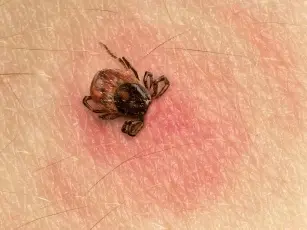 Symptoms of Lyme disease. How does the disease start?
