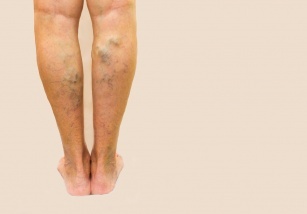 The earliest symptoms of varicose veins &#8211; how to recognize if these are the first symptoms of varicose veins?