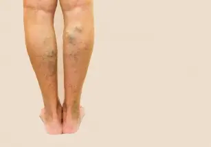 The earliest symptoms of varicose veins &#8211; how to recognize if these are the first symptoms of varicose veins?