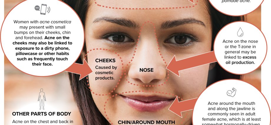 Acne on the cheeks in women: causes and how to get rid of it