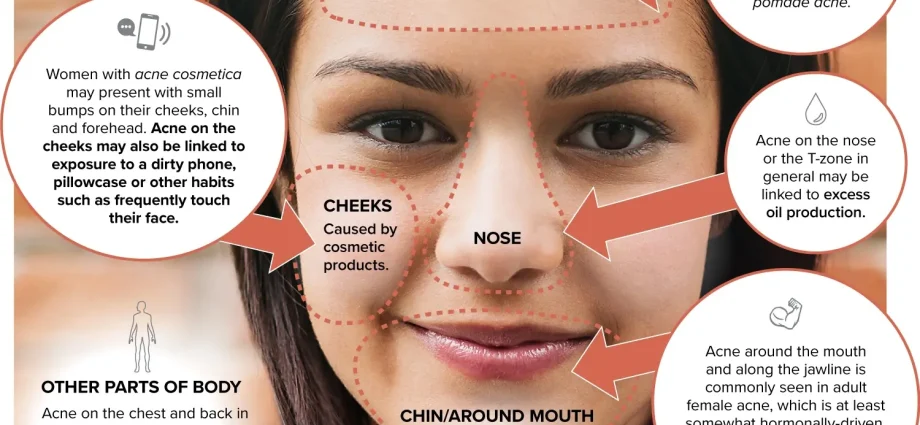 Acne on the cheeks in women: causes and how to get rid of it