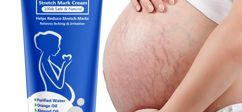 best remedy for stretch marks during pregnancy