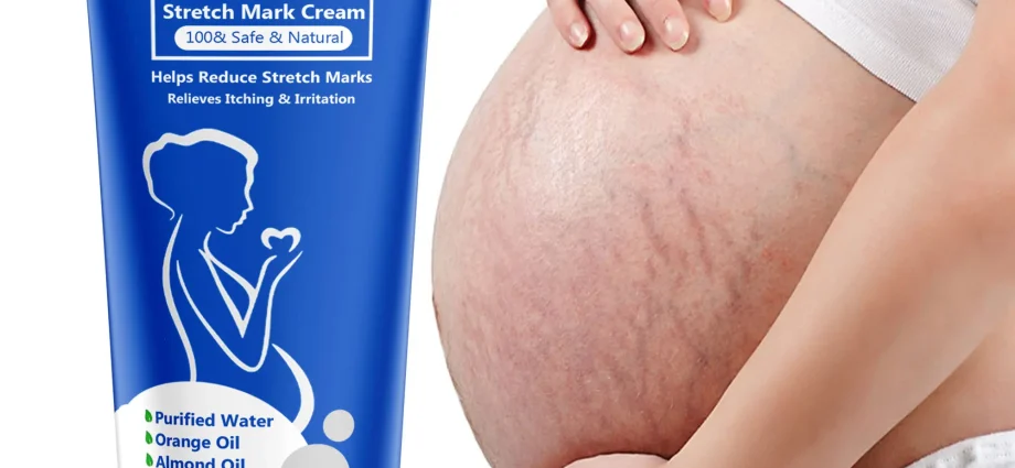 best remedy for stretch marks during pregnancy