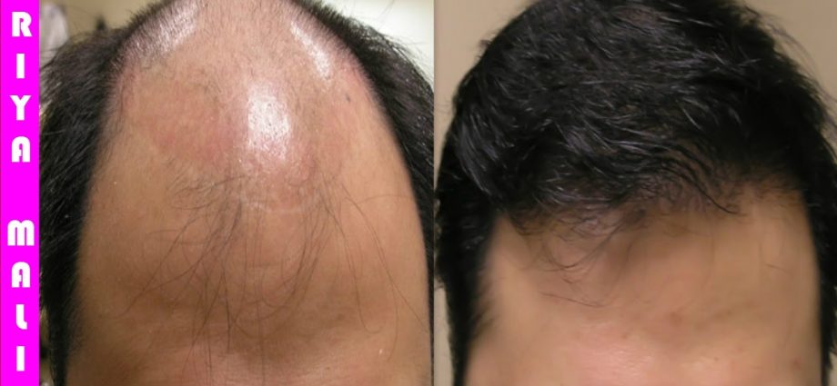 Big Loss: Hair Loss Remedies