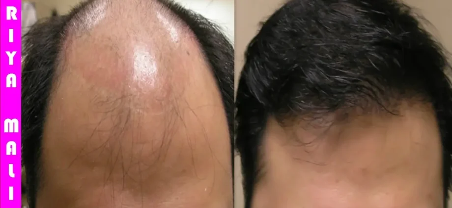 Big Loss: Hair Loss Remedies