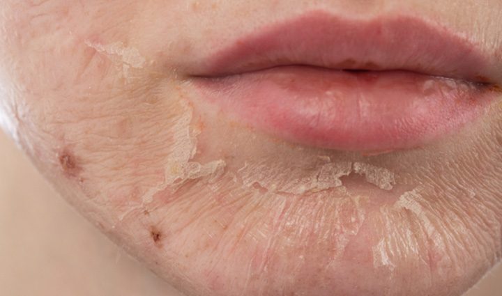 Causes of peeling skin on the face