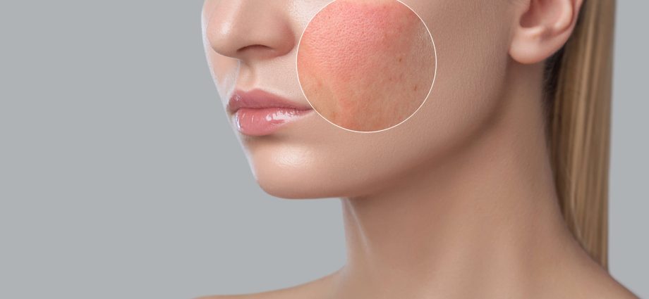 Causes of rashes on the face (in women)