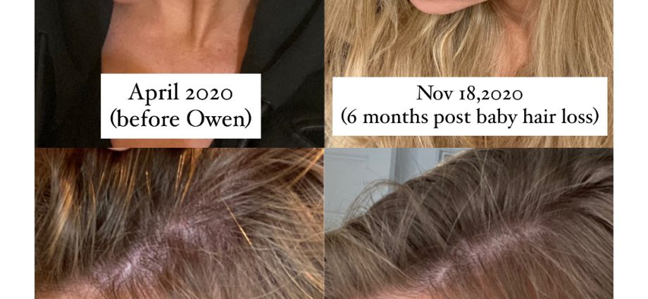 Collagen hair restoration