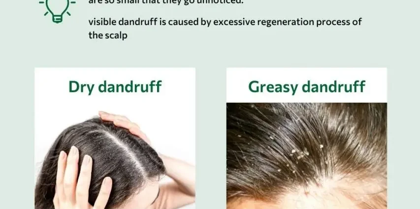 Dandruff appeared on the scalp: what to do