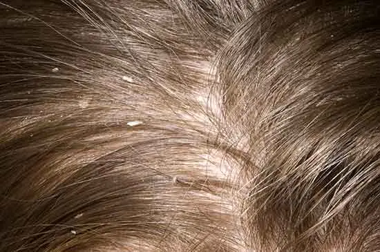 Dandruff in teenagers