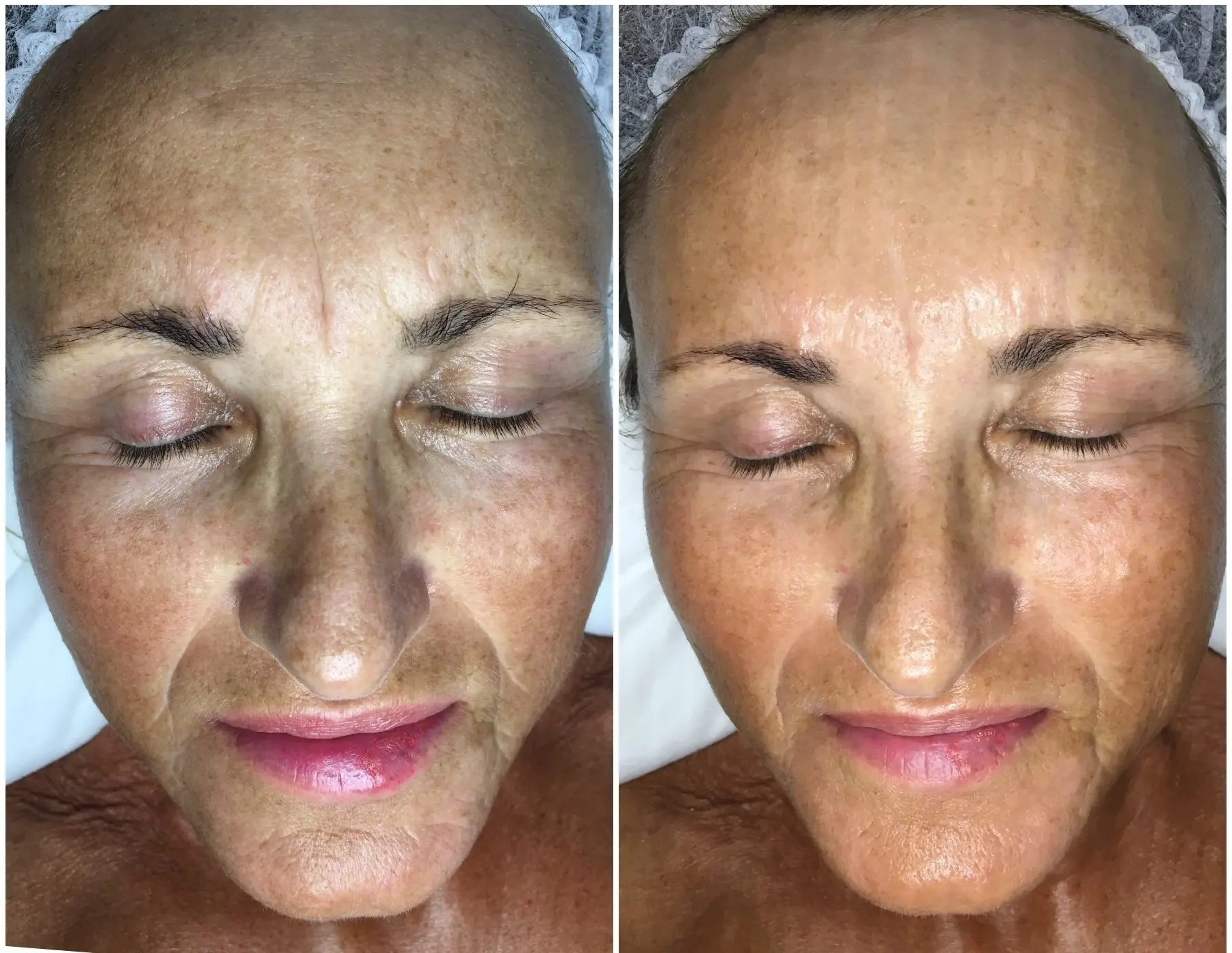 Don&#8217;t Wrinkle: A Facelift Massage