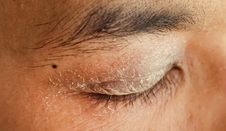 Dry eyelid skin